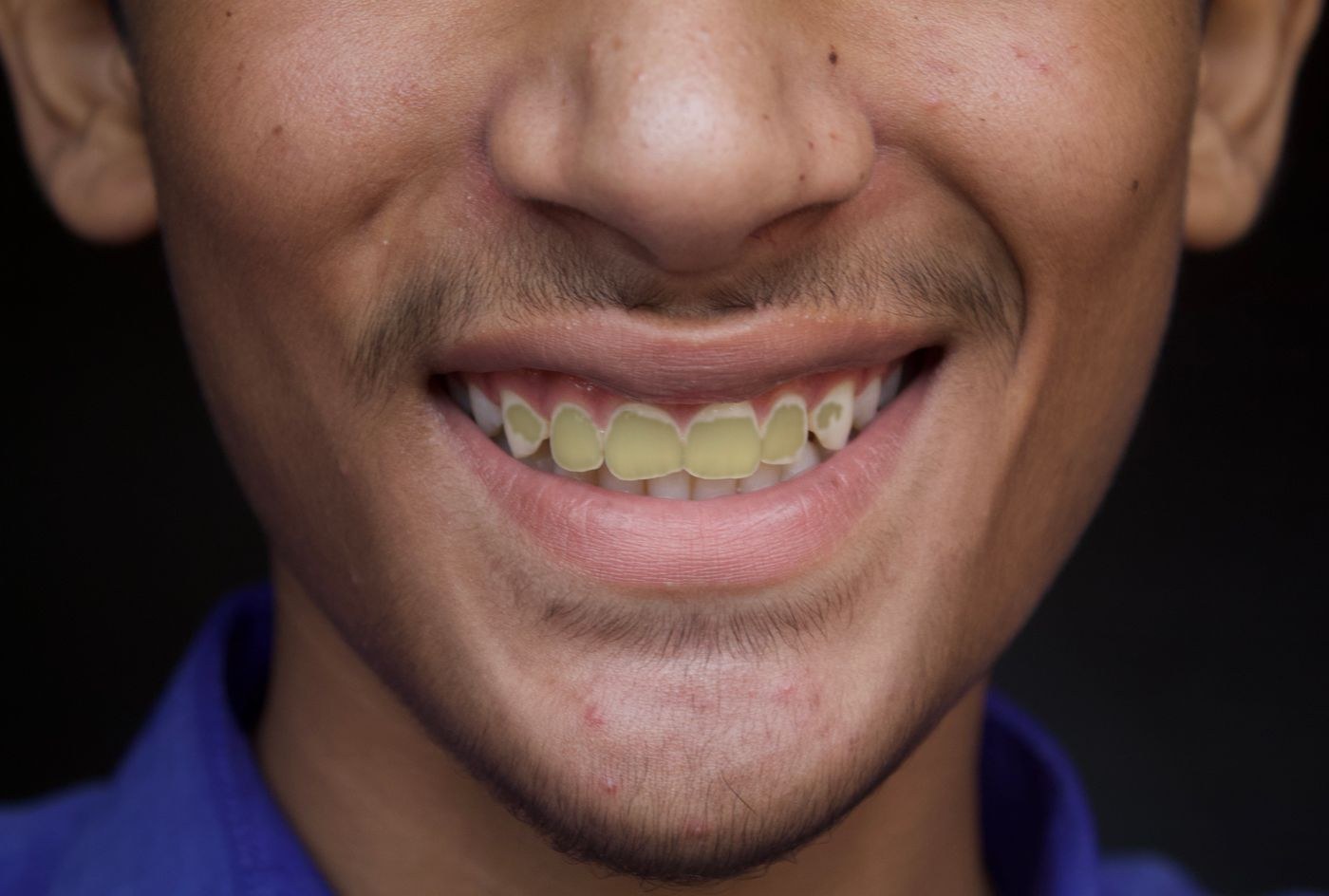 Before treatment