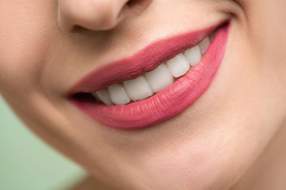 Before/after — upper arch veneers, retracted clinical shot